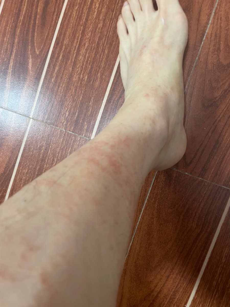 필리핀 골프치러ㅠ왔는데 이거 풀독인가요? - 뽐뿌:골프포럼 필리핀 골프치러ㅠ왔는데 이거 풀독인가요?